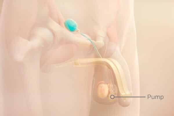 How to use a penile pump